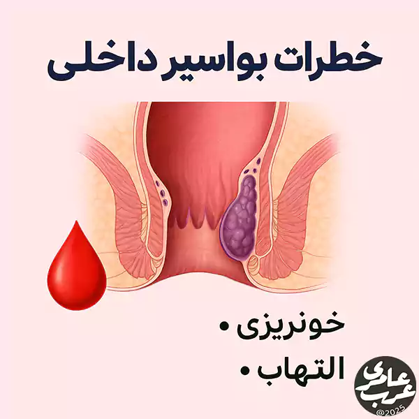 خطرات بواسیر داخلی را جدی بگیرید! با علائم، عوارض و بهترین روشهای درمان خانگی و پزشکی برای پیشگیری از خونریزی و التهاب آشنا شوید.