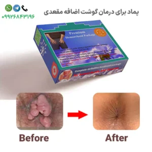 پماد برای درمان گوشت اضافه مقعدی بواسیر بیرون زده