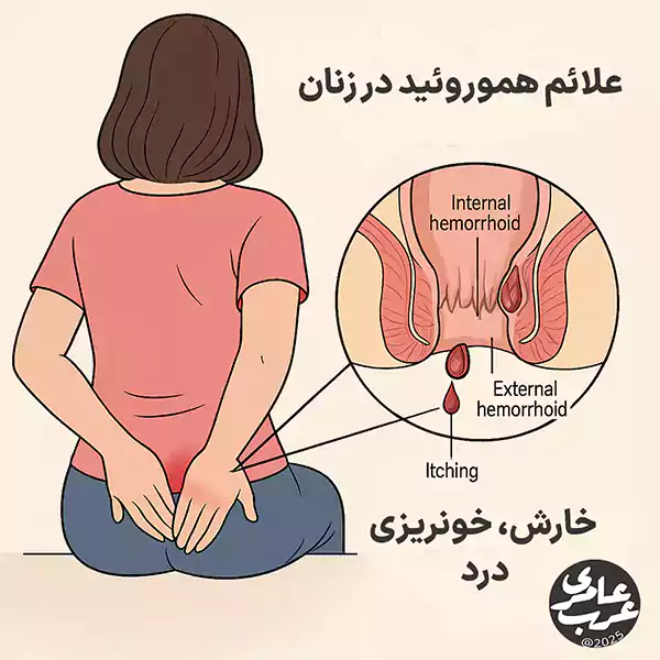 علائم بواسیر در زنان اغلب به‌صورت خارش، سوزش یا خون‌ریزی هنگام دفع ظاهر می‌شود