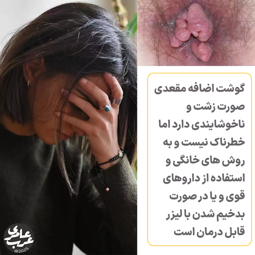 گوشت اضافه مقعدی