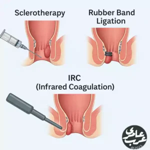اسکلروتراپی بواسیر یکی از مهم‌ترین روش‌های کلینیکی کم‌تهاجمی برای درمان بواسیر داخلی است